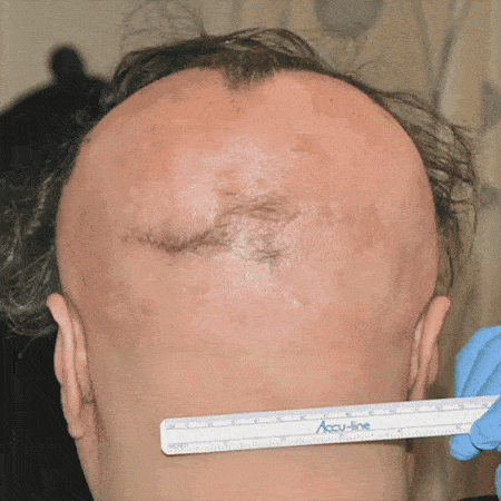 alopecia-areata-cura